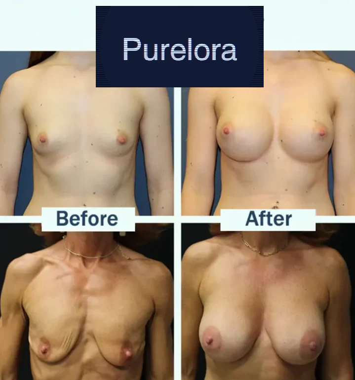 【Official Flagship Store】Purelora® Targeted Breast Enhancement Advanced Nano Microneedle Patch - Image 3