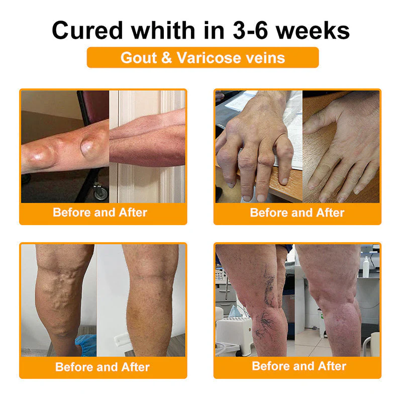 𝗙𝗗𝗔 𝗖𝗲𝗿𝘁𝗶𝗳𝗶𝗲𝗱 · 𝗢𝗳𝗳𝗶𝗰𝗶𝗮𝗹 𝗦𝘁𝗼𝗿𝗲 | Purelora®🔥 BEE VENOM LITHOSPERMUM Pain-Relief Bone Healing Cream 👑👑(Specially for older adults) - Image 3