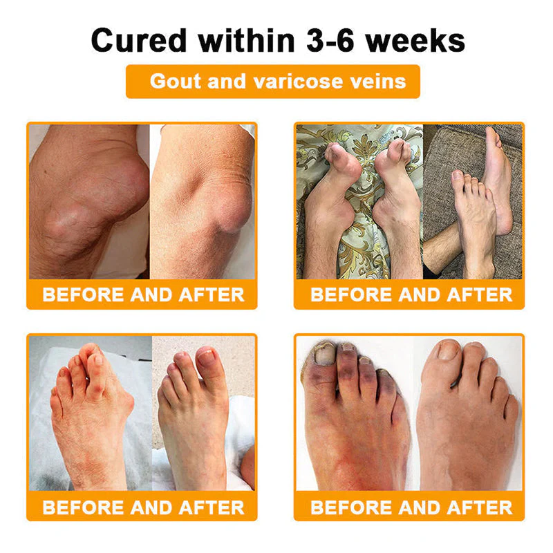 𝗙𝗗𝗔 𝗖𝗲𝗿𝘁𝗶𝗳𝗶𝗲𝗱 · 𝗢𝗳𝗳𝗶𝗰𝗶𝗮𝗹 𝗦𝘁𝗼𝗿𝗲 | Purelora®🔥 BEE VENOM LITHOSPERMUM Pain-Relief Bone Healing Cream 👑👑(Specially for older adults) - Image 4