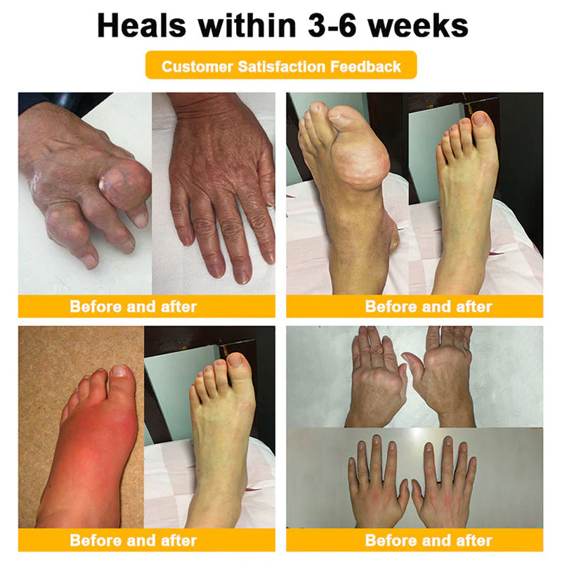 𝗙𝗗𝗔 𝗖𝗲𝗿𝘁𝗶𝗳𝗶𝗲𝗱 · 𝗢𝗳𝗳𝗶𝗰𝗶𝗮𝗹 𝗦𝘁𝗼𝗿𝗲 | Purelora®🔥 BEE VENOM LITHOSPERMUM Pain-Relief Bone Healing Cream 👑👑(Specially for older adults) - Image 6